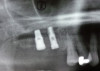 Fig 8. Two no-prep lithium disilicate veneers were created for the lateral incisors to blend with posterior restorations and the natural central incisors.