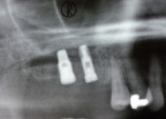 Figure  3  Postoperative panoramic radiographs of implants placed into maxillary alveolar ridge bilaterally (Surgical Stage 1).