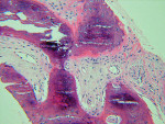 Figure  5   Histological evaluation at UCSF laboratory 3 months after GBR: Puros shows a sclerotic woven and lamellar bone with no foreign material, full bone integration, and moderate degree of vascularization.