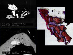 Figure  9  BSEM and histological evaluation (light microscopy) of Puros 9 months after grafting and 6 months after implant insertion at Progentix laboratory show evenly distributed new bone formation.