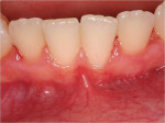 Figure  1  Narrow zone of keratinized tissue with high frenum attachment on teeth Nos. 24 and 25.
