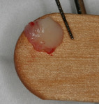 Figure  4  An epithelialized-free soft-tissue autograft was harvested from the operculum.