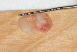 Figure  6  The fully prepared autograft with epithelialized half on the left and connective tissue-only half on the right.