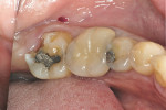 Figure 1  Preoperative view of the mandibular left second molar.