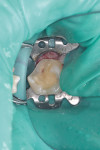 Figure 2  The tooth was restored with composite resin under rubber dam isolation.