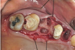 Figure 6  Surgical site after flap elevation and extractions of the hopeless teeth.