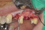 Figure 8  Recreation of the biologic width on the maxillary left second premolar.