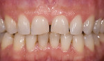 Figure 4  Preoperative view of a patient presenting with a desire for longer, fuller teeth and diastema closure.
