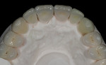 Figure 7  View of anticipated porcelain restorations on the cast.