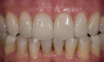 Figure 9: Post-cementation view of the extended coverage porcelain veneers.