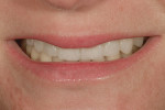 Figure 14  Postoperative view of the patient’s natural smile.