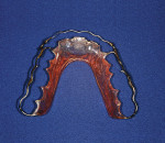 Figure 6  Kois deprogrammer was prepared with a narrow 2-mm to 3-mm wide anterior incisor platform, which would allow for a single mandible incisor contact point on the deprogrammer.