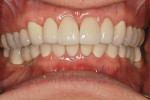 Figure 16  Posttreatment retracted frontal view. Note leveling of the pre-maxilla gingiva and the lower occlusion line, lengthening of the four maxilla incisors, and buccal inclination of the maxillary molars.