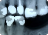 Figure 7. Seated screw-retained crown with screw access hole closed.