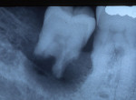 Figure 6  Chronic apical periodontitis and apical cyst showing early external root resorption.