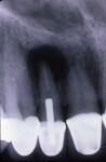 Figure 7  Chronic apical periodontitis and apical cyst showing early external root resorption.