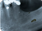 Figure 9: Photograph after flap was elevated (Fig 8). Note buccal resorptive defect; postoperative radiograph with gutta-percha fill of root canal and root defect filled with amalgam (Fig 9).