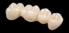 Figure 75 - Posterior Oblique Mandibular Occlusal