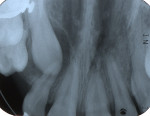 Figure 15  Impaction-associated resorption. Palatal impacted upper right cuspid and upper right lateral incisor after orthodontic treatment of impacted cuspid in radiograph. Note apical root resorption of lateral incisor. Upper left second molar 2 ye