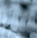Figure 16  Impaction-associated resorption. Palatal impacted upper right cuspid and upper right lateral incisor after orthodontic treatment of impacted cuspid in radiograph. Note apical root resorption of lateral incisor. Upper left second molar 2 ye