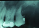 Figure 17  Impaction-associated resorption. Palatal impacted upper right cuspid and upper right lateral incisor after orthodontic treatment of impacted cuspid in radiograph. Note apical root resorption of lateral incisor. Upper left second molar 2 ye