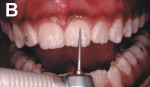 Figure 2  Application of fine-tapered bur No. 3195 FF, on the vestibular surfaces of the superior and inferior incisive and pre-molar teeth.