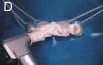 Figure 4  After enamel microabrasion and during polishing with fluoride paste.