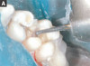 Figure 7  Remove the custom-fitted tray that has been made directly in the mouth over the orthodontic brackets.