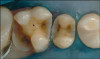 Figure 12  After removal of the brackets, there are no yellow spots or unbleached areas on the teeth, and no white spots from demineralization of the enamel.