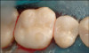 Figure 13  Any yellow or discolored areas on the teeth will generally be attributed to the composite bonding material, which penetrates 25 µm into the enamel, and must be removed by abrasion.