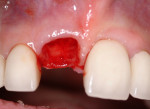 Figure 2   Note the soft-tissue integrity after extraction.