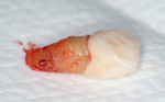 Figure 3  The tooth was extracted due to an apical post perforation.