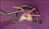 Fig 7. Resin-bonded bridge after removal, implant placement, and bridge recementation.