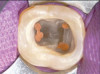 Fig 9. Veneer preparations of incisors and zirconia abutment of right lateral incisor, 13 days after exposure of implant head (second stage surgery).