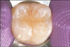 Fig 10. Implant crown and incisor veneers 14 days after exposure of implant.