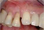 Figure 8  Type II socket. The patient presented with a history of attachment loss on tooth No. 5.