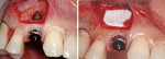 Figure 9; Immediate implant placement shows an apical bone defect as a result of a cyst. The access flap is limited to the apical portion of the implant. PerioGlas® (NovaBone Products, LLC, www.novabone.com) was grafted with a resorbable collagen membran