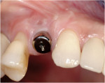 Figure 10  Soft-tissue maintenance was achieved with the use of a healing abutment. Note the retention of the soft-tissue form both facially and interproximally.