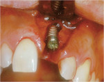 Figure 14  Immediate implant placement shows significant bone loss in the coronal aspect of the socket.