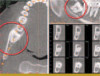 Figure 6. Glass-ionomer cement used as a base or liner prior to composite placement in deeply excavated lesions.