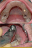 Figure 10. Diamond strips used for interproximal finishing can also be used to clear the contact when teeth are accidentally bonded together.