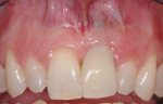 Figure 17  The provisional restoration 5 months post-implant placement shows a sufficiently maintained gingival margin. An amalgam tattoo is present in the apical area as a result of the original retrograde filling.