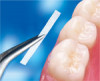 (6.) Acrylic resin being placed over the occlusal surfaces of the mandibular denture teeth.