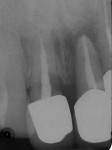 Figure 19  Radiograph shows coronal and apical bony defects.
