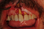 Figure 20  Surgical entry shows loss of buccal plate. Inadequate bone is present for implant placement. In this case, guided bone regeneration and soft-tissue augmentation should be performed.