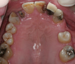 Figure 3  Occlusal view of maxilla at presentation.