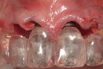 Figure 6  Anatomically correct surgical guide with 2.8-mm direction indicators for sites Nos. 8 and 9. Ideal final placement will be 3.5 mm from the mid-buccal of the template to allow for adequate prosthetic emergence profile.