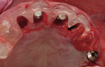Figure 7  3.5-mm direction indicators are in place. Osteotomy site preparation is along the palatal walls of Nos. 8 and 9, leaving a buccal horizontal defect dimension of 2 mm to 3 mm requiring GBR.