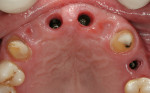 Figure 13  Healthy soft tissues are noted in the subgingival transitional zones after removal of the healing abutments.