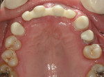 Figure 15  Try-in of the zirconia overcases, which were then sent to the lab for porcelain addition.